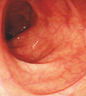 大腸の観察像例
