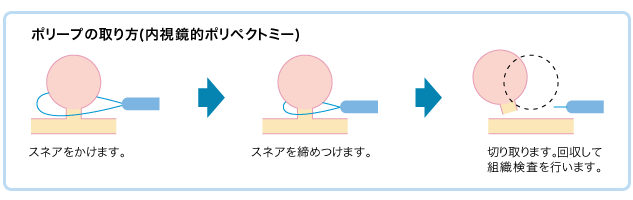 平坦・陥凹型の取り方