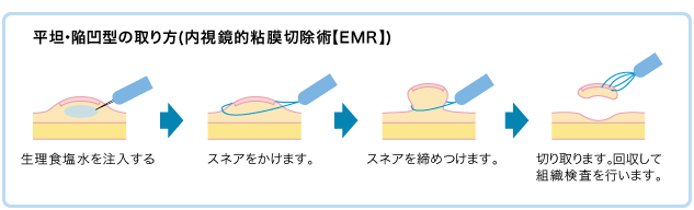 ポリープの取り方